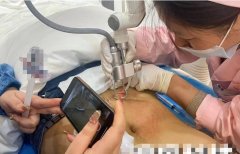 妊娠紋用什么儀器能去除？妊娠紋修復儀器廠家_最新祛妊娠紋的儀器